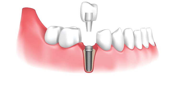 Dentist Supports